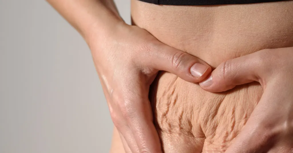 Stretch Mark Treatment